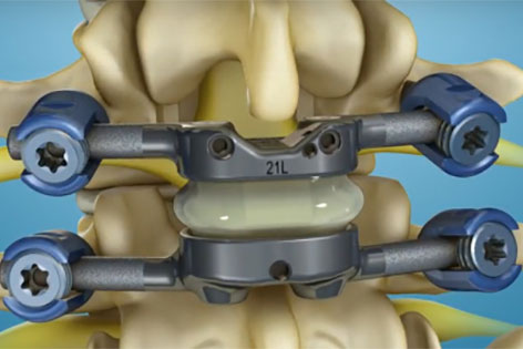 The TOPS device now being tested in a clinical trial could relieve back pain and preserve patients' motion.